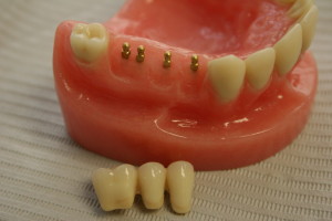 Mini Dental Implants